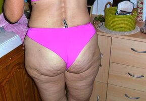 cellulite culoni (1).JPG